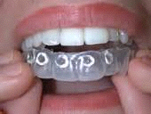 blanquejament_en_clinica_dental-2