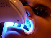 blanquejament_en_clinica_dental-3